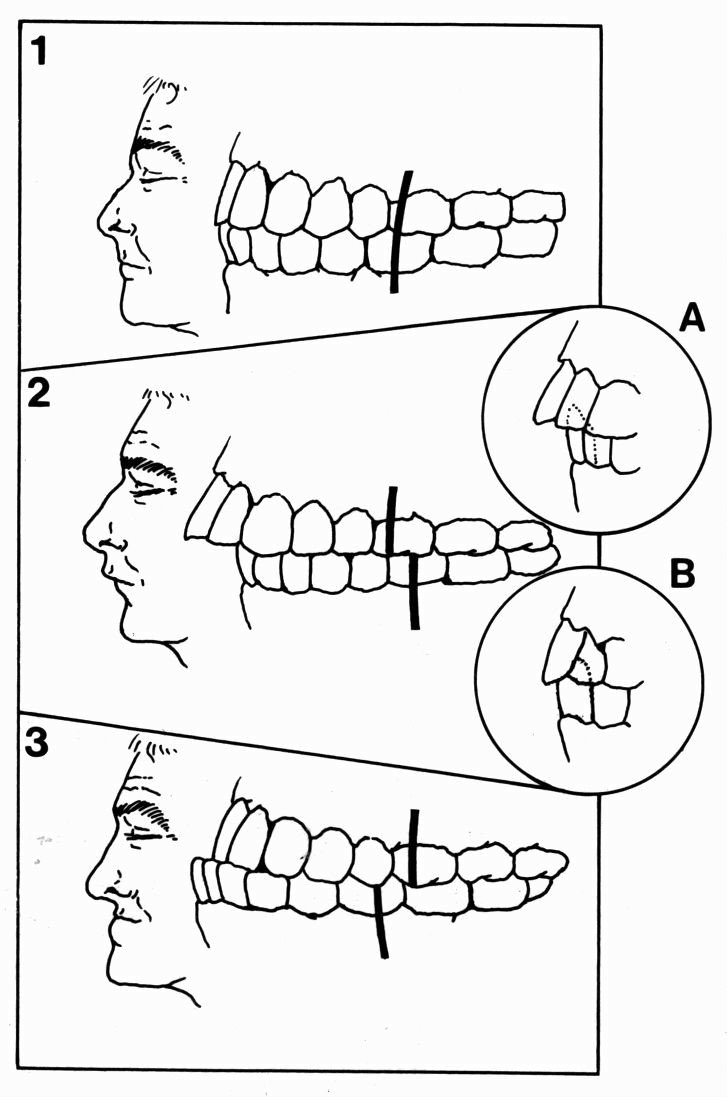 QU’EST-CE QUE LA CHIRURGIE ORTHOGNATHIQUE ?