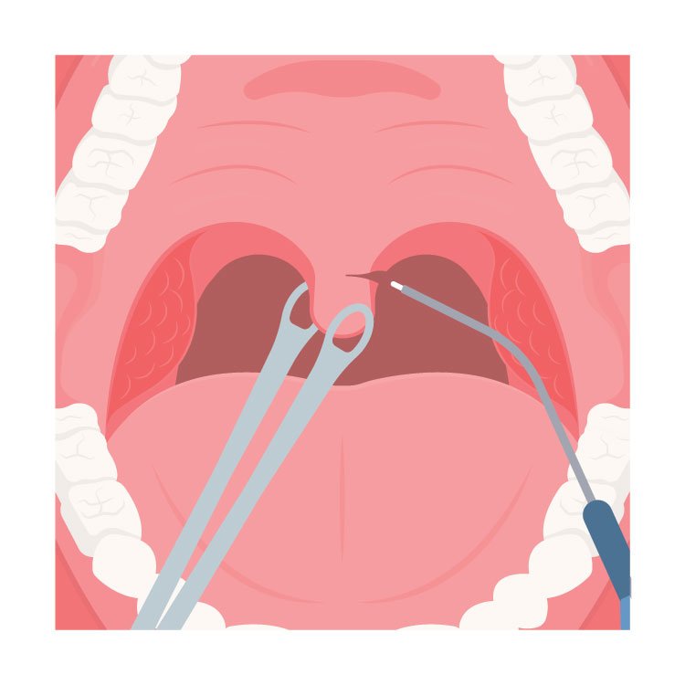 Chirurgie du ronflement chez le dr Olivier Esnault à Paris